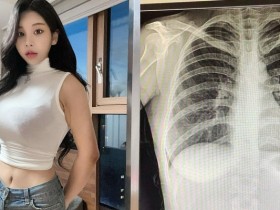 【WPT扑克】南韓「百萬網紅」不滿被質疑整形…曬 X 光照自證清白：我沒有動過手術